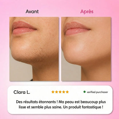 Névea - Le premier kit complet en 3 étapes qui affaiblit et dissout les poils hormonaux, sans douleur ni irritation.